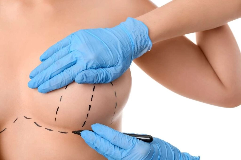 mamoplastia sendo desenhada no peito de uma mulher